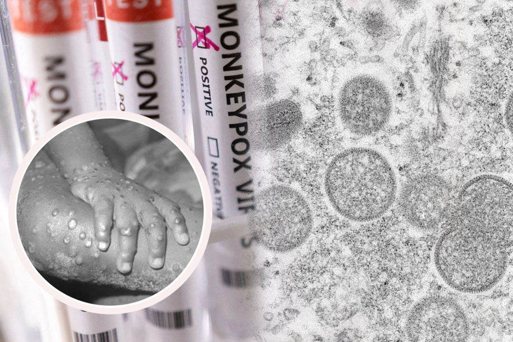 National task force vs. monkeypox sought