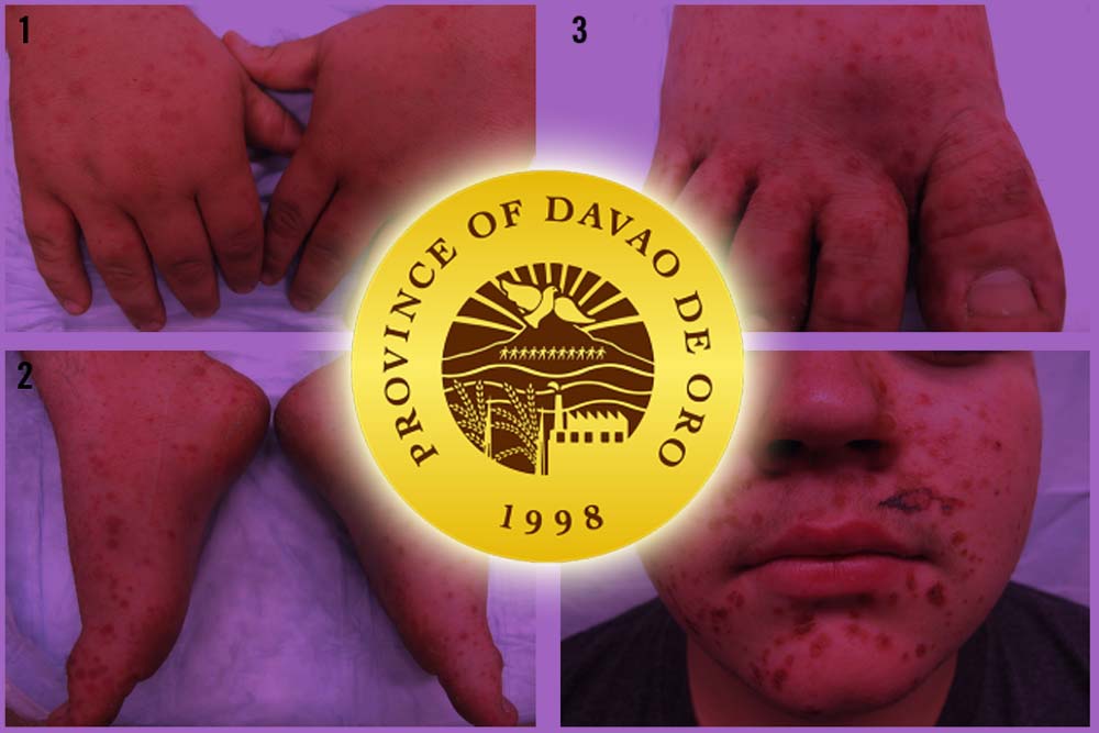 Davao Oro logs 418 HFMD cases, info drive up